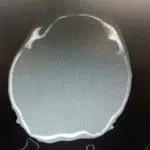 Plagiocefalia, craneosinostosis, cráneo